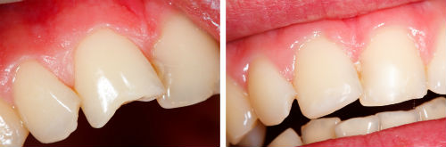 Dental Bonding, Dr. Stewart, Rockledge, FL Dentist